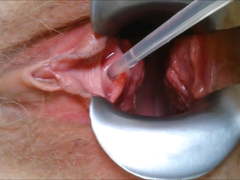 Urethra Catheter Speculum